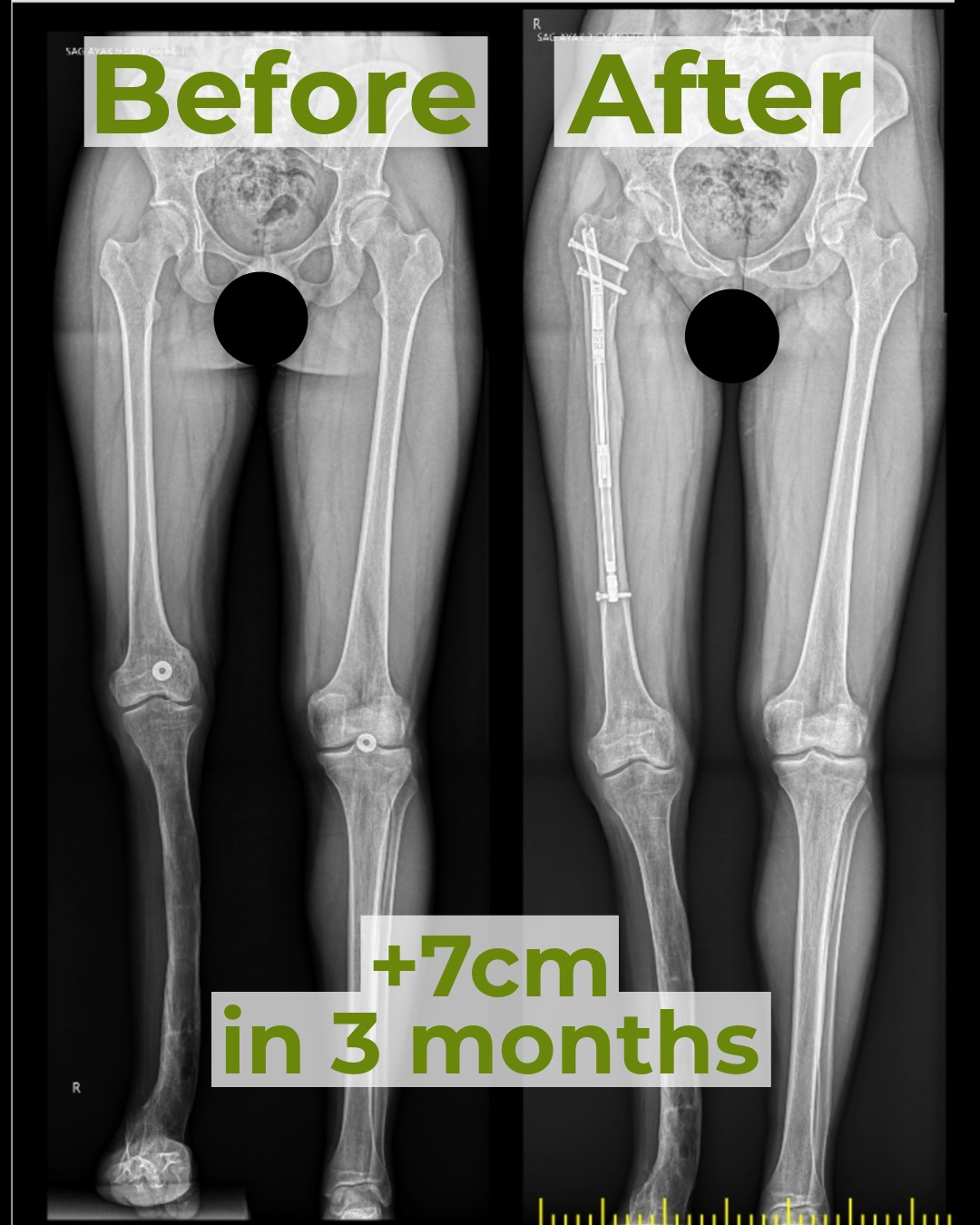 GoLengthening | Premium Cosmetic Stature Lengthening